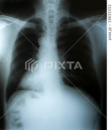 X-Ray image, chest men for medical diagnosis. X-Ray image, chest men for medical diagnosis. 19635352