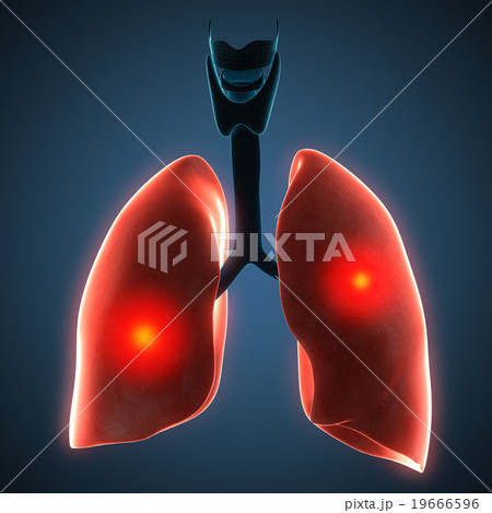 Disease illustration of human lungs. 19666596
