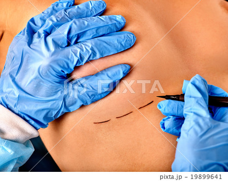 Doctor makes dotted line on female breast . 19899641