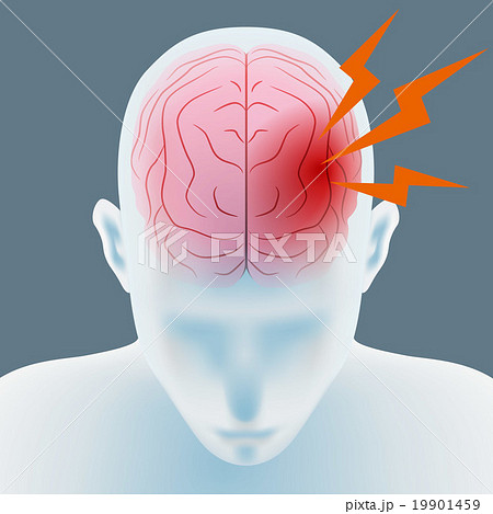 頭痛 脳梗塞 脳内出血 イメージイラストのイラスト素材