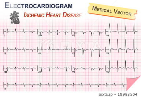 Electrocardiogram ( ECG , EKG ) Electrocardiogram ( ECG , EKG ) 19983504