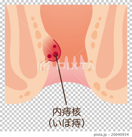 痔 肛門 断面図のイラスト素材