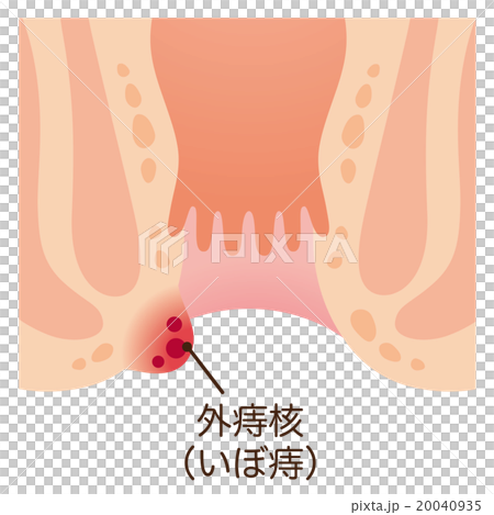 痔　肛門　断面図 20040935