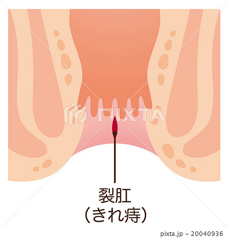 痔 肛門 断面図のイラスト素材