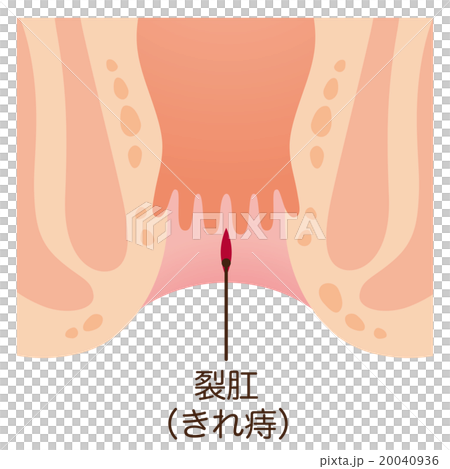痔　肛門　断面図 20040936