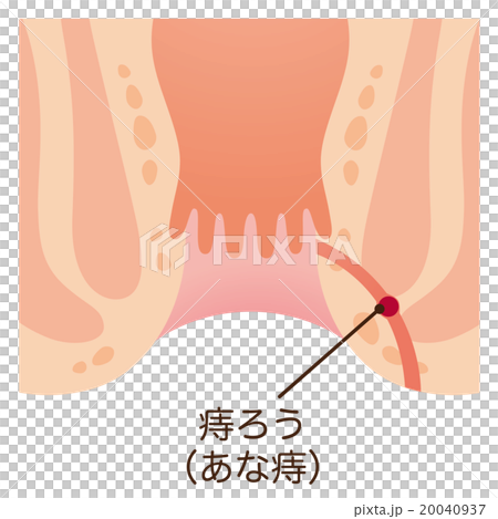 痔　肛門　断面図 20040937