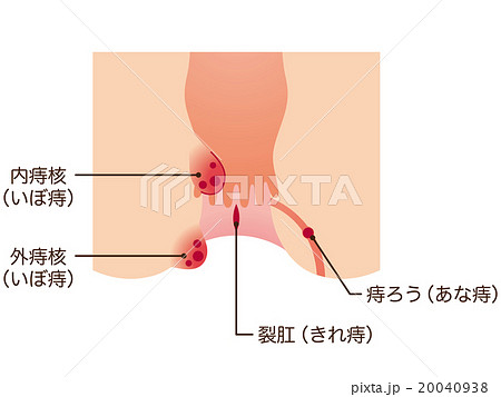 痔　肛門　断面図 20040938