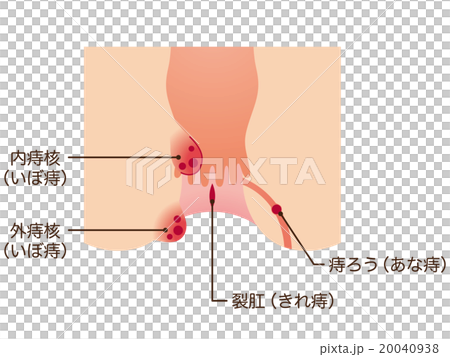 痔　肛門　断面図 20040938