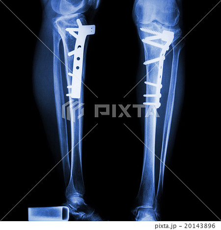 fracture tibia(leg bone) 20143896