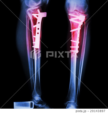 fracture tibia(leg bone) 20143897