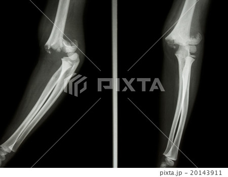 Supracondylar humerus fracture Supracondylar humerus fracture 20143911