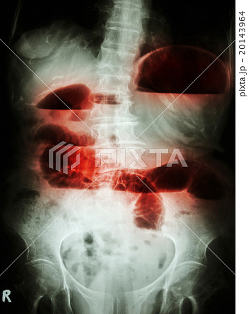small bowel obstruction 20143964