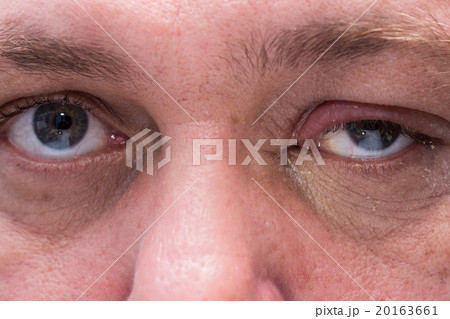 Close up of infected eye 20163661