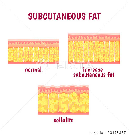 leather sectional layer of subcutaneous fat 20173877