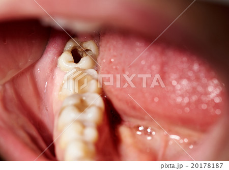 Damaged tooth with cavity dental caries decay 20178187