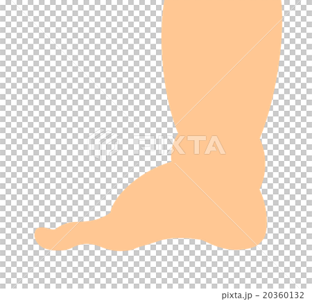 Swollen legs 20360132