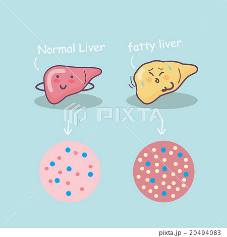 Health liver vs Fatty liver Health liver vs Fatty liver 20494083