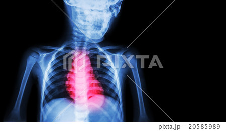 Ischemic Heart Disease , Myocardial Infarction Ischemic Heart Disease , Myocardial Infarction 20585989