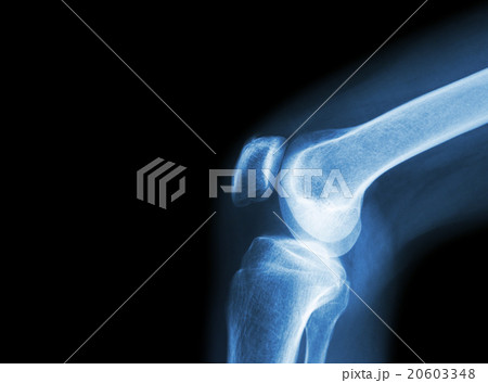Film x-ray knee joint with arthritis 20603348