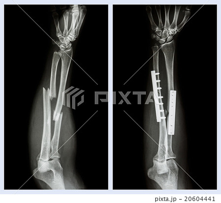 Fracture both bone of forearm 20604441