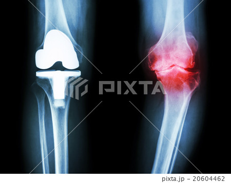 film x-ray knee of osteoarthritis knee film x-ray knee of osteoarthritis knee 20604462