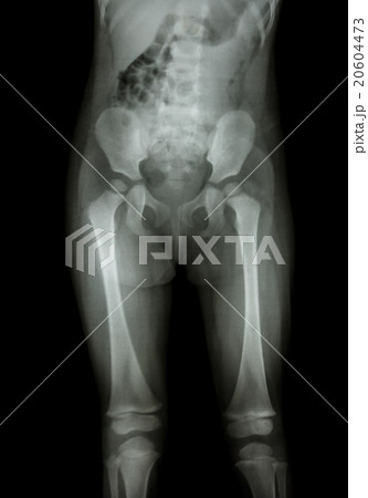 Film x-ray normal body of child Film x-ray normal body of child 20604473