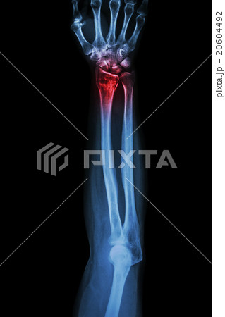 Fracture distal radius (wrist bone) Fracture distal radius (wrist bone) 20604492