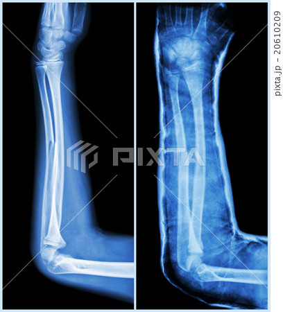 Fracture shaft of ulnar bone ( forearm bone ) 20610209