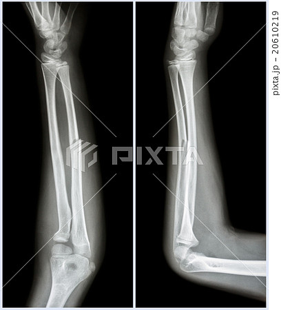 Fracture shaft of ulnar bone ( forearm bone ) 20610219