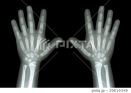 X-ray both child hands on black background X-ray both child hands on black background 20610349