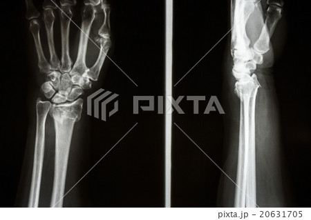 Colles' fracture 20631705