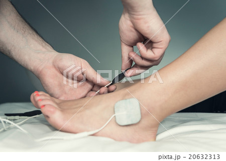 Placing TENS electrodes on foot 20632313