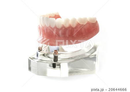 オーバーデンチャー 20644666