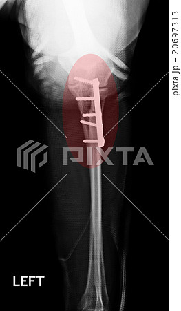Fracture Elbow, forearm x-rays image 20697313