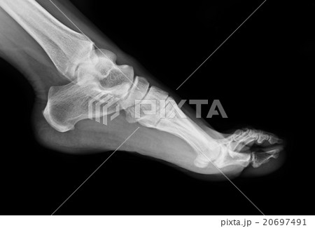 x-ray of foot x-ray of foot 20697491