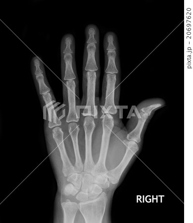 X-Ray Hand. 20697620