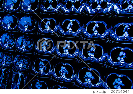 research in medicine. CT scan of the patient. research in medicine. CT scan of the patient. 20714044