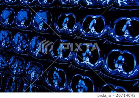 research in medicine. CT scan of the patient. research in medicine. CT scan of the patient. 20714045