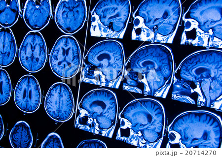research in medicine. CT scan of the patient. research in medicine. CT scan of the patient. 20714270