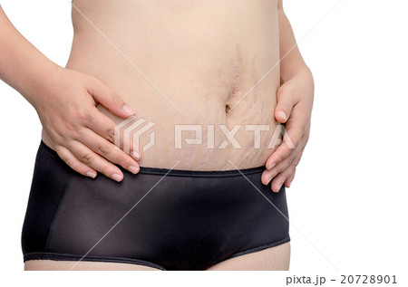 Asian woman showing stretchmarks on her belly 20728901