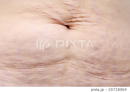 Close up stretch marks on Asian woman belly 20728904