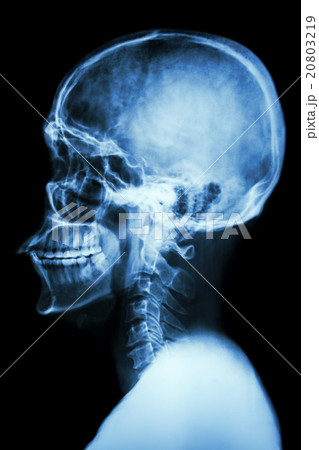 X-ray asian skull and cervical spine 20803219