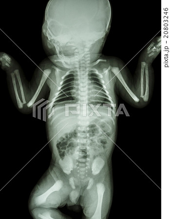 film x-ray whole infant's body film x-ray whole infant's body 20803246