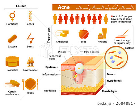 Acne. skin problems. medical infographics. 20848917