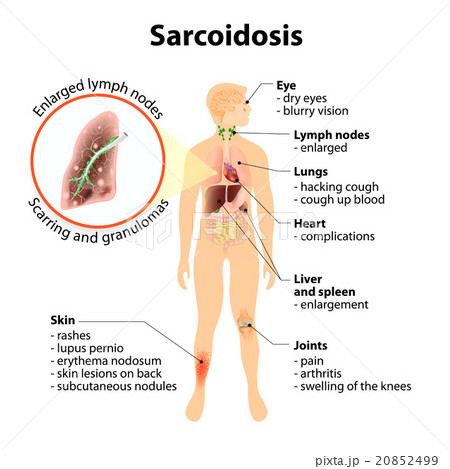 Sarcoidosis signs and symptoms 20852499