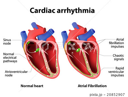 Cardiac arrhythmia 20852907