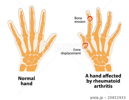 Normal hand and Rheumatoid Arthritis Normal hand and Rheumatoid Arthritis 20852933