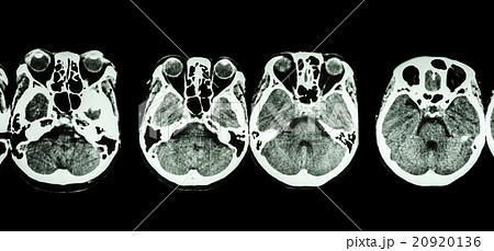 CT scan of brain and base of skull CT scan of brain and base of skull 20920136