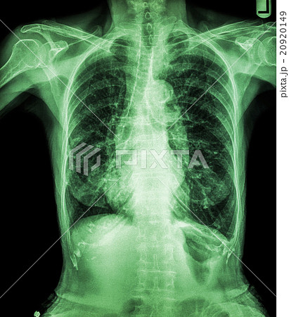 Chest X-ray of old patient Chest X-ray of old patient 20920149