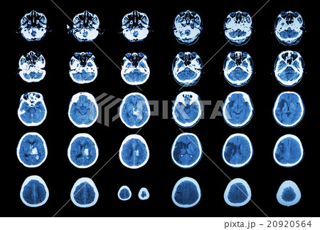 Hemorrhagic Stroke and Ischemic Stroke Hemorrhagic Stroke and Ischemic Stroke 20920564